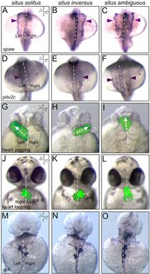 Understanding laterality disorders and the left-right organizer: Insights from zebrafish